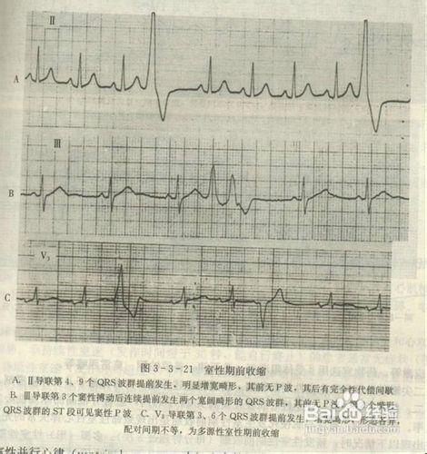 教你如何看懂心電圖