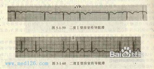 教你如何看懂心電圖