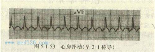 教你如何看懂心電圖