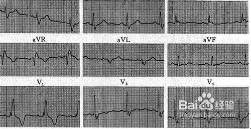 教你如何看懂心電圖