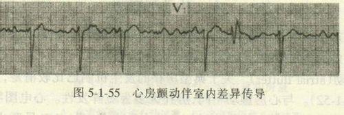 教你如何看懂心電圖