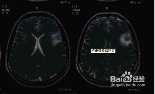 癲癇病最新的治療方法