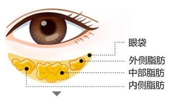 去眼袋最好方法