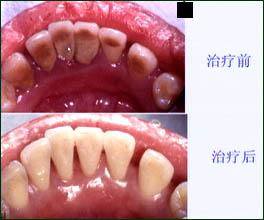 牙周病應該如何治療？