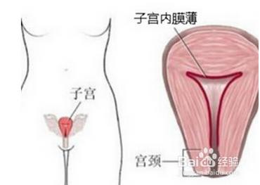 引發子宮腺肌症的原因