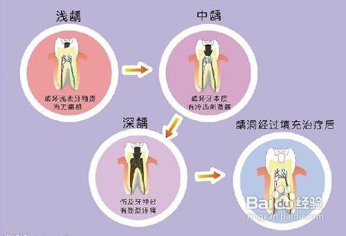 齲齒--補牙的過程