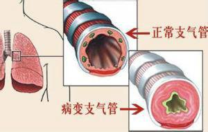 如何治療慢性支氣管炎