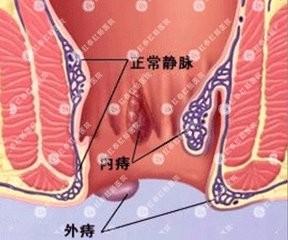 孕婦痔瘡治療體會