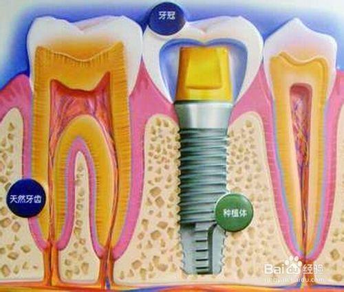 種植牙選擇哪種材料好
