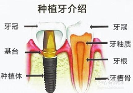 種植牙選擇哪種材料好