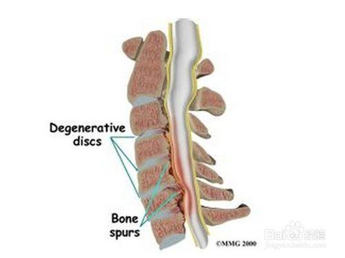 頸椎骨質增生怎麼辦