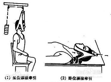 頸椎病能做牽引治療嗎