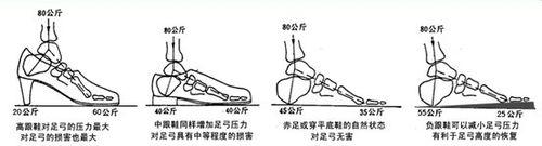 扁平足矯正方法最新訊息，用負跟鞋為扁平足減壓