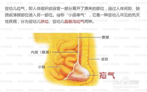 臍疝——寶寶的第一次生病