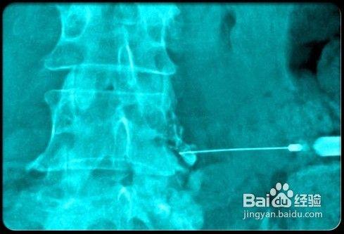 緩解和治療腰痛的方法