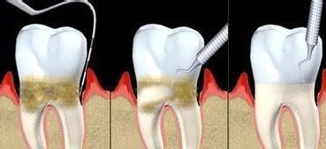 牙周炎不及時治療會有哪些危害呢?