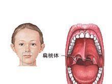 扁桃體炎要避免哪些危害