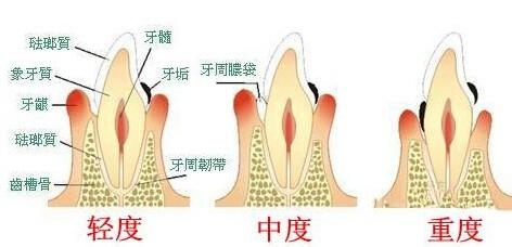 牙周炎不及時治療會有哪些危害呢?