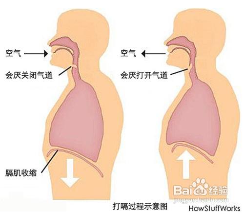 怎樣快速治療打嗝