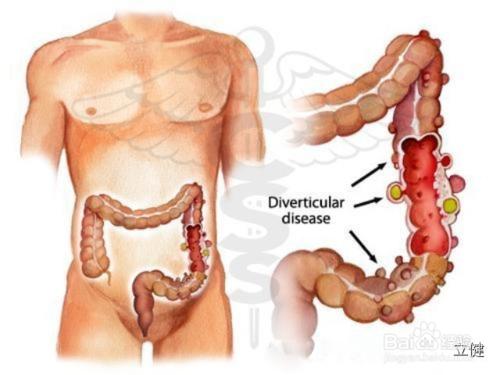 腸道與健康 大腸憩室：腸道也會像車胎一樣鼓包