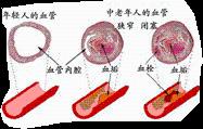 高血脂的症狀及治療