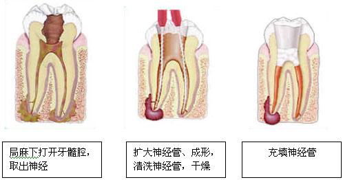 緊急止牙髓炎引起的牙痛方法