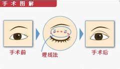 做埋線雙眼皮多少錢