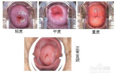 宮頸糜爛有什麼症狀