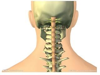 頸椎骨質增生的圖片症狀