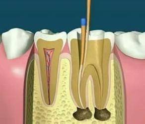 講解一下牙齒根管治療