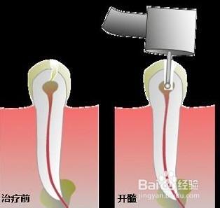 講解一下牙齒根管治療