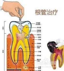 講解一下牙齒根管治療