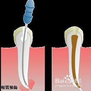 講解一下牙齒根管治療