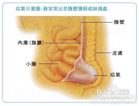 岔氣是怎麼回事