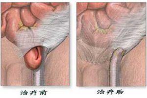 岔氣是怎麼回事