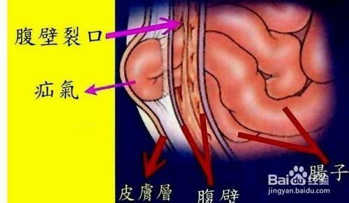 老年人疝氣如何治療