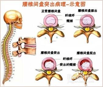 腰椎間盤突出是什麼原因引起的