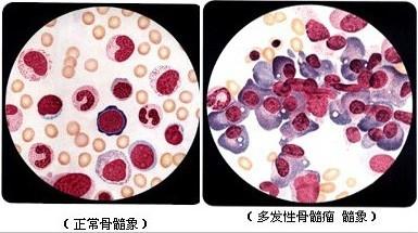 原發性骨髓纖維化要做哪幾項檢查