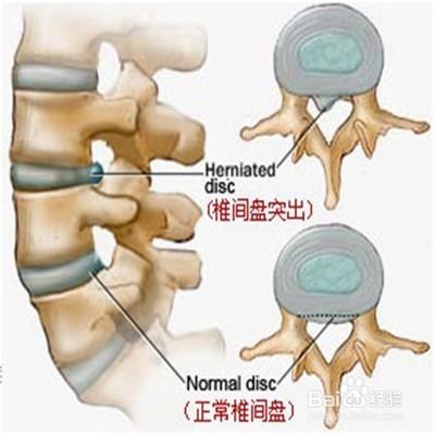 得了腰間盤突出怎麼辦