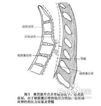 引起頸椎椎管狹窄的常見原因有哪些?