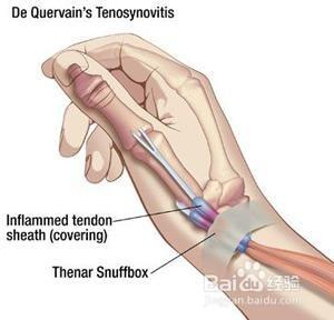 腱鞘炎怎麼治療