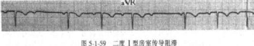 如何認識能顯示心電圖診斷水平的心電圖