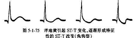 心電圖之ST-T複習經驗分享