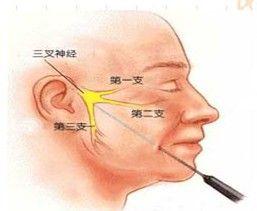 三叉神經痛怎麼治療有效