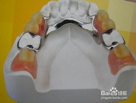 單顆牙缺失如何修復