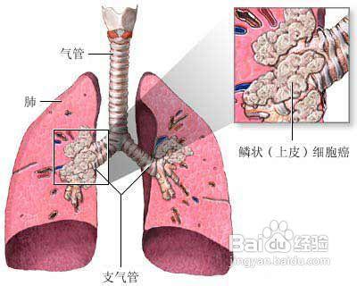 非小細胞肺癌晚期症狀