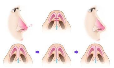 鼻尖整形方法的有哪些