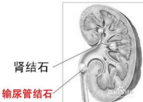 怎麼通過飲食有效預防尿結石