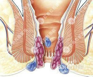 帶你認識常見病：[12]痔