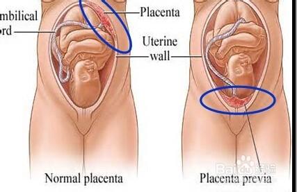 關於前置胎盤的知識